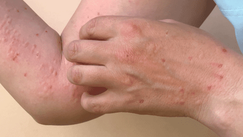 7 địa phương ghi nhận 56 ca nhiễm đậu mùa khỉ
