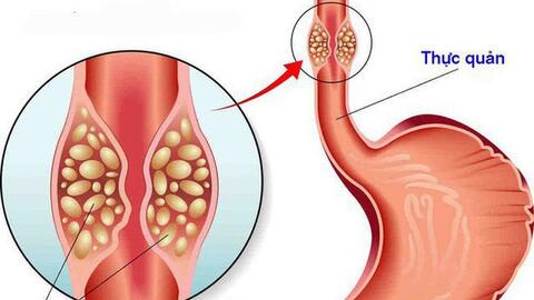 5 thói quen của người Việt gây ung thư thực quản, cái thứ 2 nhiều người mắc, ai không có xin chúc mừng!