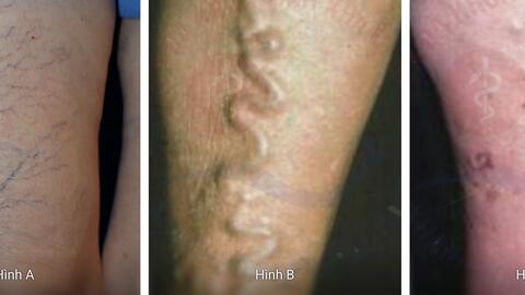 Bác sĩ cảnh báo dấu hiệu suy tĩnh mạch chi dưới