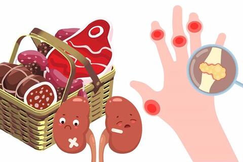 Loại thịt khiến axit uric tăng vọt và đẩy nhanh suy thận