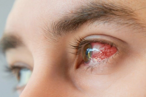 Cảnh báo huyết áp cao qua những biểu hiện ở mắt