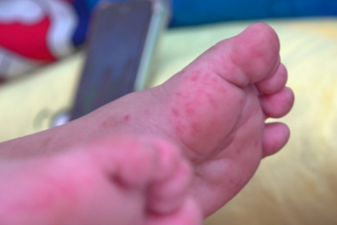 Dịch bệnh tay chân miệng xuất hiện tại tất cả các xã, phường của Hà Nội