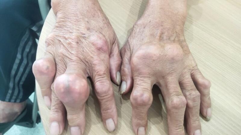5 món ăn giúp kiểm soát axit uric, hỗ trợ hạn chế hạt tophi