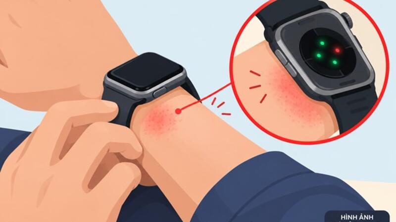 Apple Watch Series 12 và Ultra 4 bị người dùng phản ánh kích ứng da