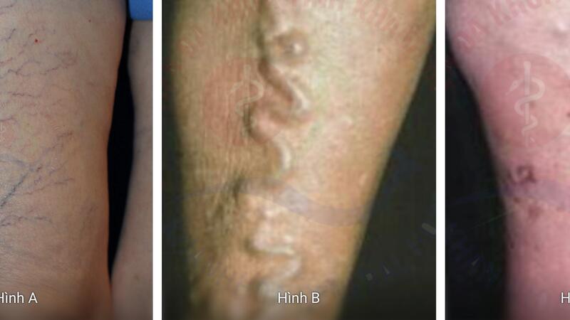 Bác sĩ cảnh báo dấu hiệu suy tĩnh mạch chi dưới