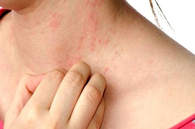 8 việc cần làm khi bị sẩn ngứa, nổi mày đay hậu COVID-19 - Ảnh 2.