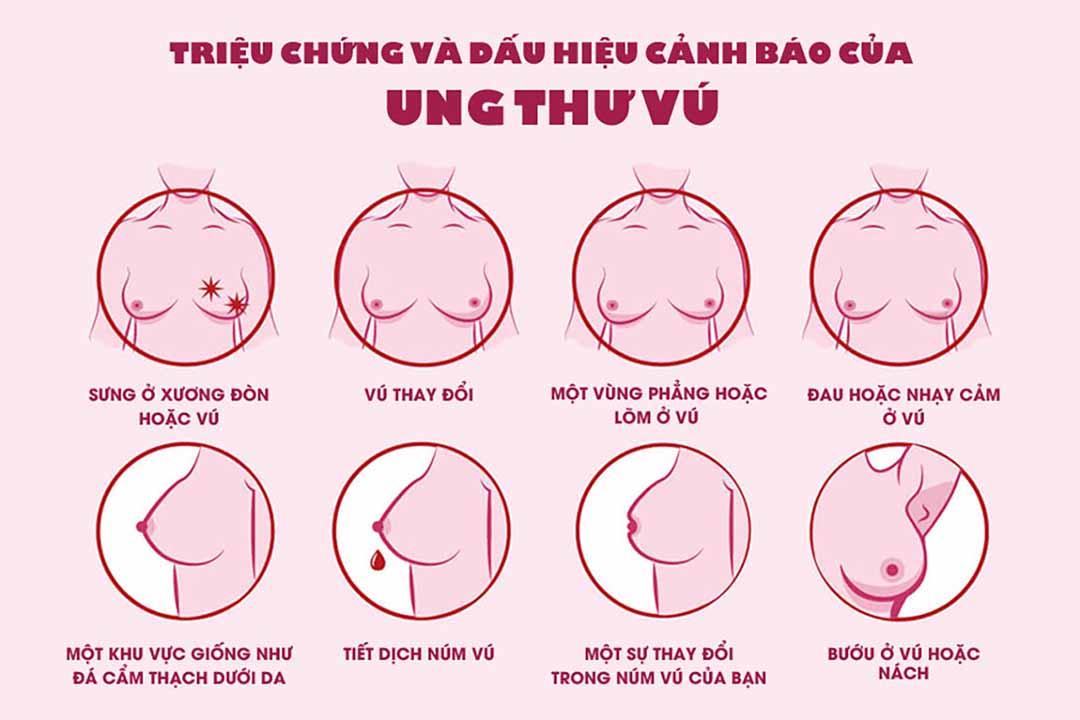 Những điều cần biết về ung thư vú - Ảnh 2. Những điều cần biết về ung thư vú - Ảnh 2.