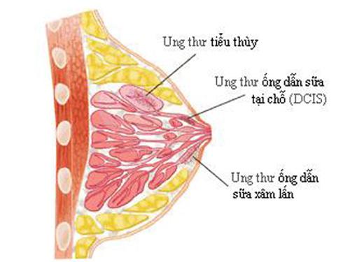 Những điều cần biết về ung thư vú - Ảnh 1. Những điều cần biết về ung thư vú - Ảnh 1.