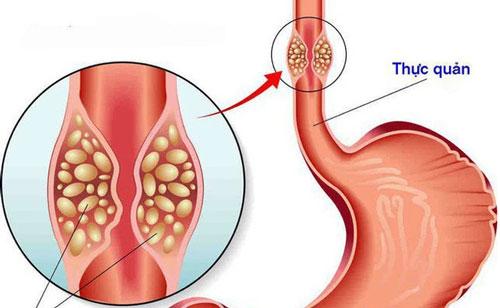 Đi khám viêm họng, bệnh nhân bất ngờ phát hiện mắc ung thư thực quản - Ảnh 1.