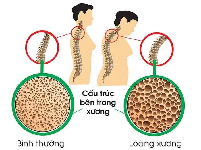 Lối sống lành mạnh giúp giảm thiểu nguy cơ loãng xương ở phụ nữ mãn kinh - Ảnh 2.