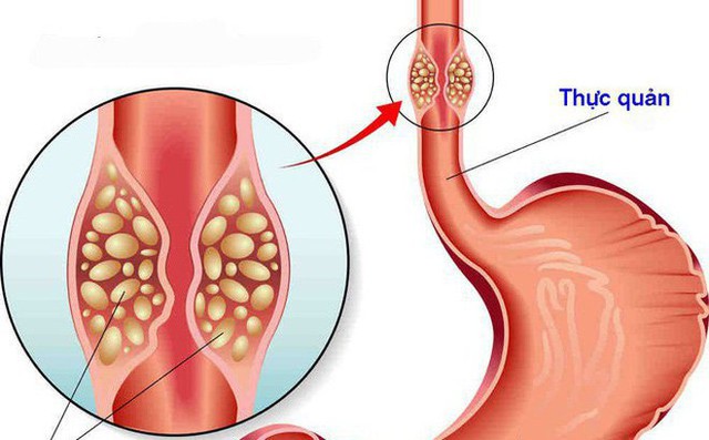 5 thói quen của người Việt gây ung thư thực quản, cái thứ 2 nhiều người mắc, ai không có xin chúc mừng! - Ảnh 2.