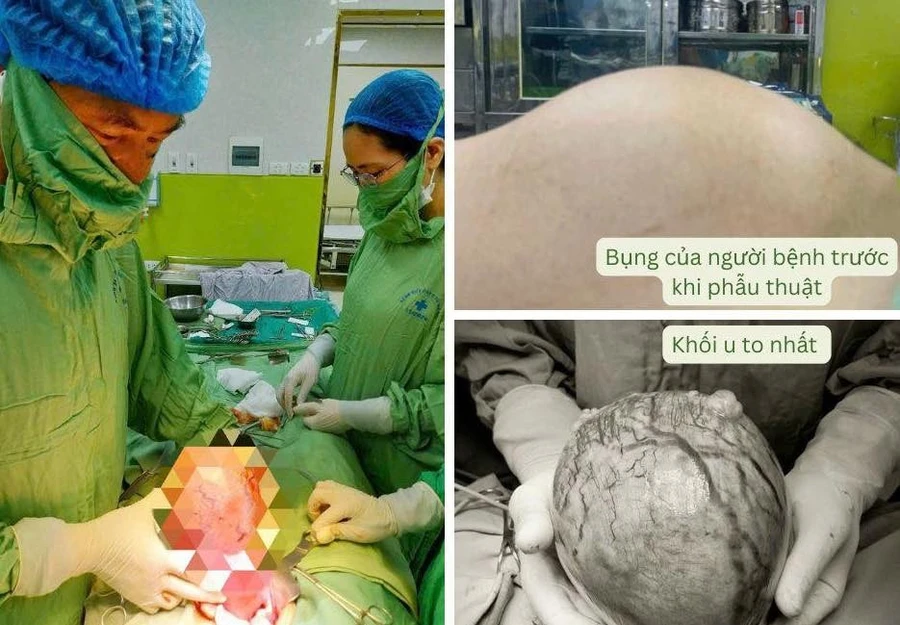 Các bác sĩ phẫu thuật lấy khối u cho bệnh nhân. Ảnh: BVCC