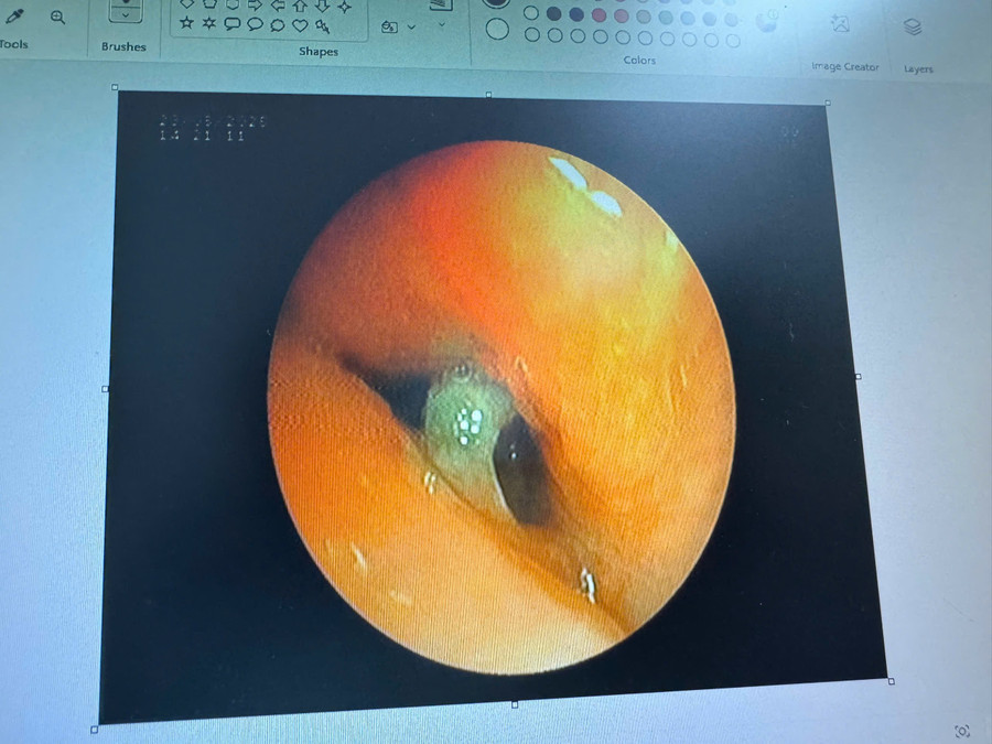 Mảnh xương bị mắc trong phế quản cụ bà. hinh-anh-noi-soi-phe-quan.jpg