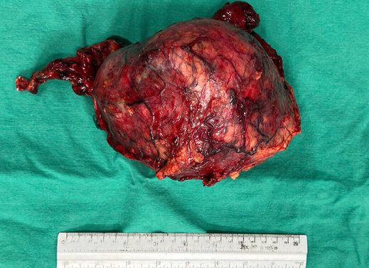Khối u thận “khổng lồ” sau khi được cắt bỏ. Ảnh: BVCC