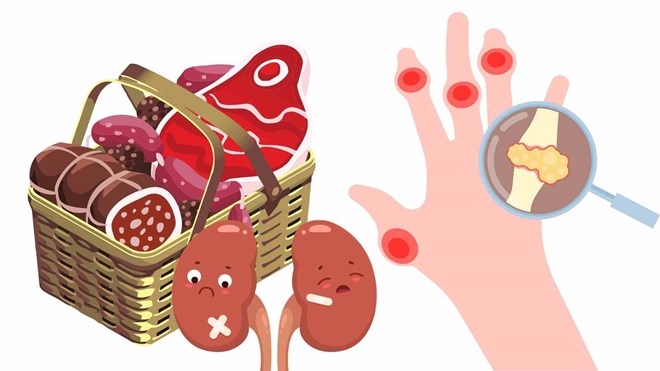 Loại thịt khiến axit uric tăng vọt và đẩy nhanh suy thận