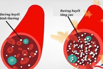 Nhận biết những dấu hiệu cảnh báo đường huyết đang tăng cao