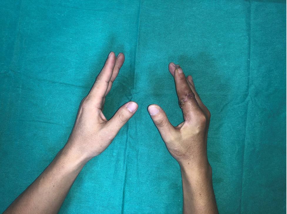 Ca phẫu thuật diễn ra thành công với ngón tay được nối liền sau 25 giờ. Ảnh: BVCC