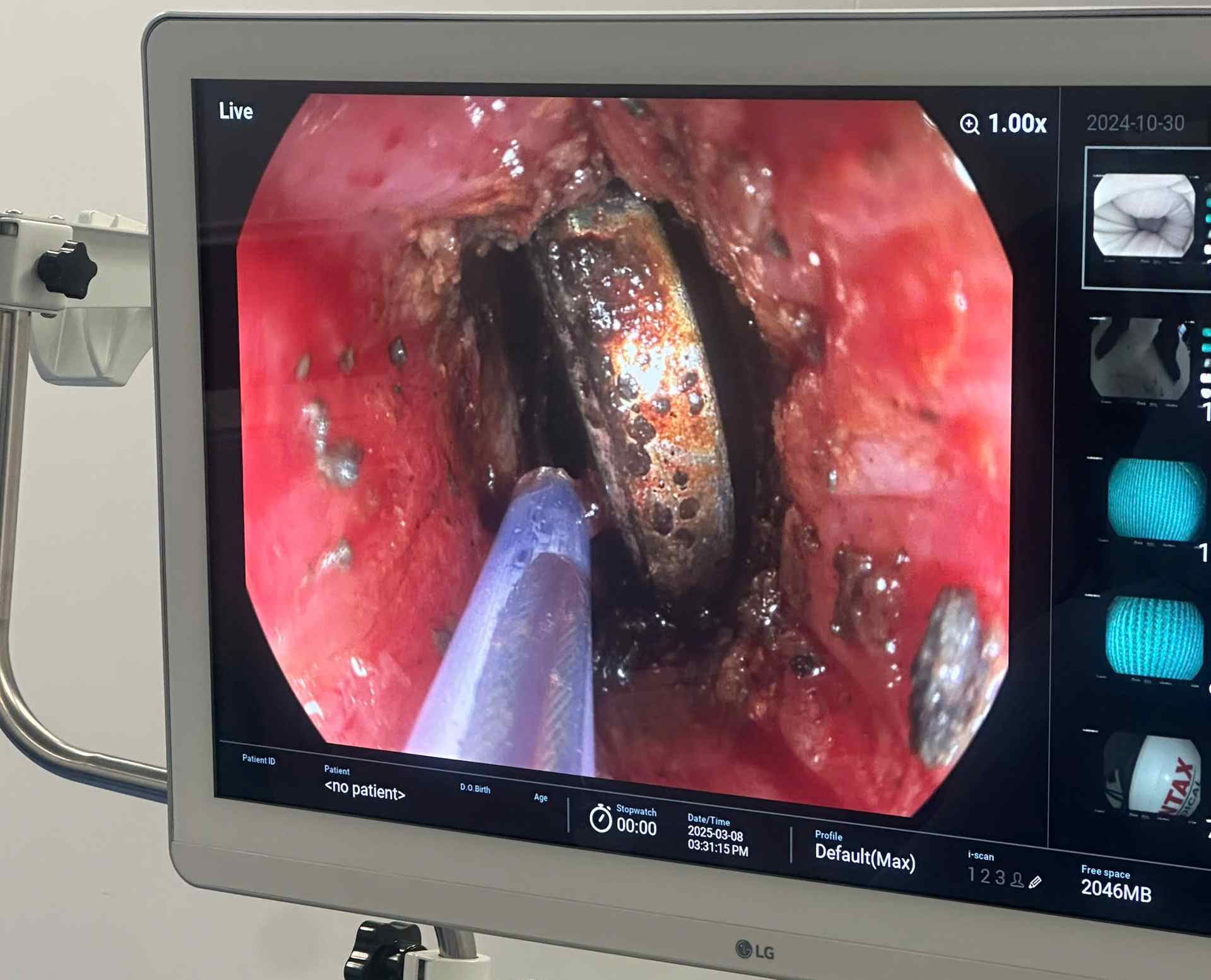 Theo các bác sĩ, trong số các ca tai nạn thương tích thường xuyên gặp phải là trẻ nuốt phải dị vật. Ảnh: BVCC