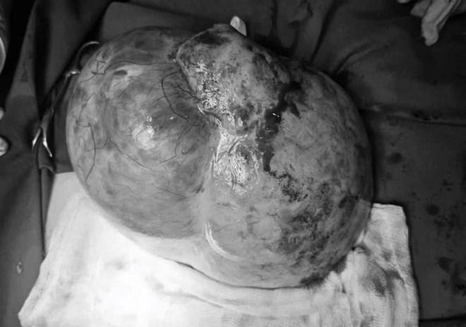 Phát hiện ung thư tinh hoàn khi bụng to nhanh bất thường